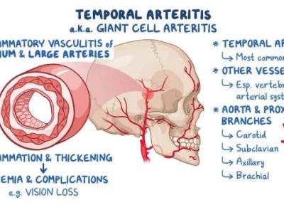 چرا سردرد شقیقه پس از 50 سالگی همواره باید جدی گرفته گردد؟ چرا سردرد شقیقه پس از 50 سالگی همواره باید جدی گرفته گردد؟